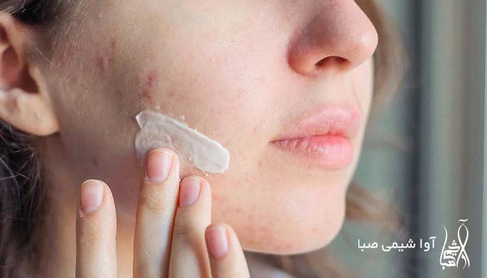 Salicylic Acid For Acne