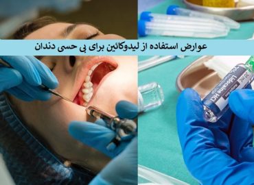 لیدوکائین برای دندان