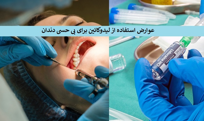 لیدوکائین برای دندان